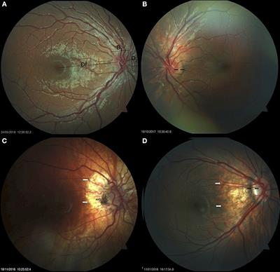 Abnormalities of the Optic Nerve in Down Syndrome and Associations With Visual Acuity